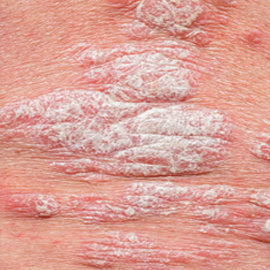 Psoriasis Treatments in Thiruvananthapuram