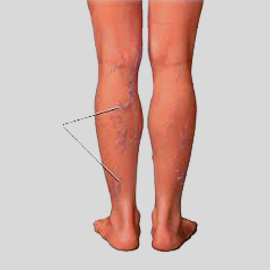 varicose vein ayurvedic Treatment in Thiruvananthapuram